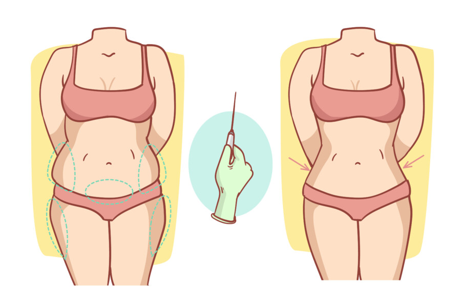 Lipoaspiração é a cirurgia plástica mais realizada no Brasil