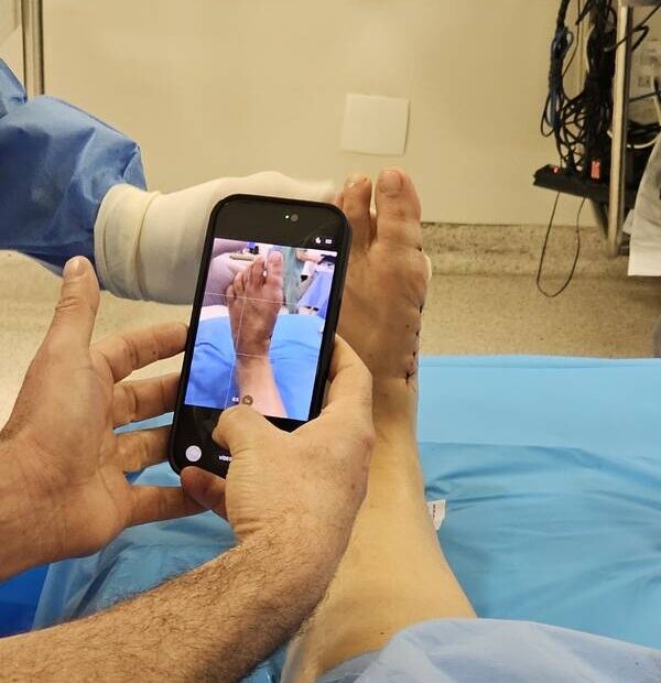 Tratamento das joanetes avança com cirurgia pouco invasiva