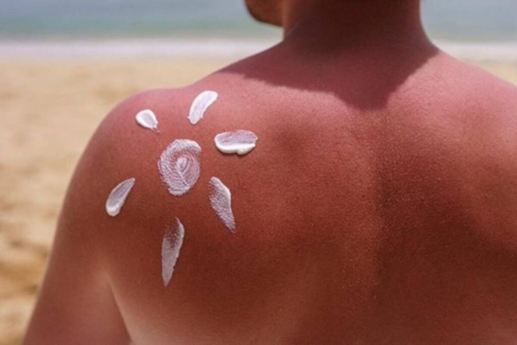 NoSunscreen: movimento viral preocupa especialistas