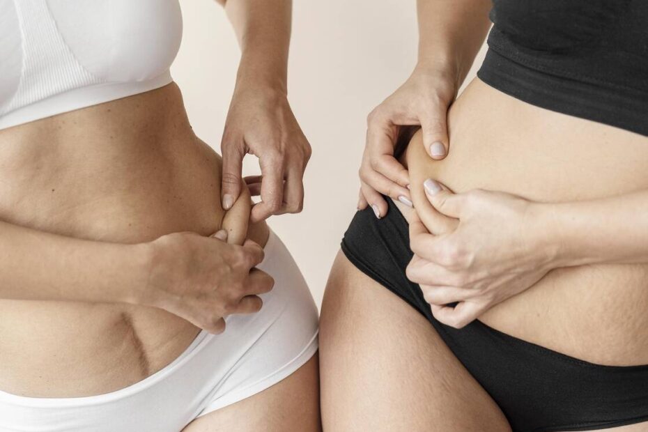 Lipoaspiração exige cuidados médicos rigorosos, alerta especialista