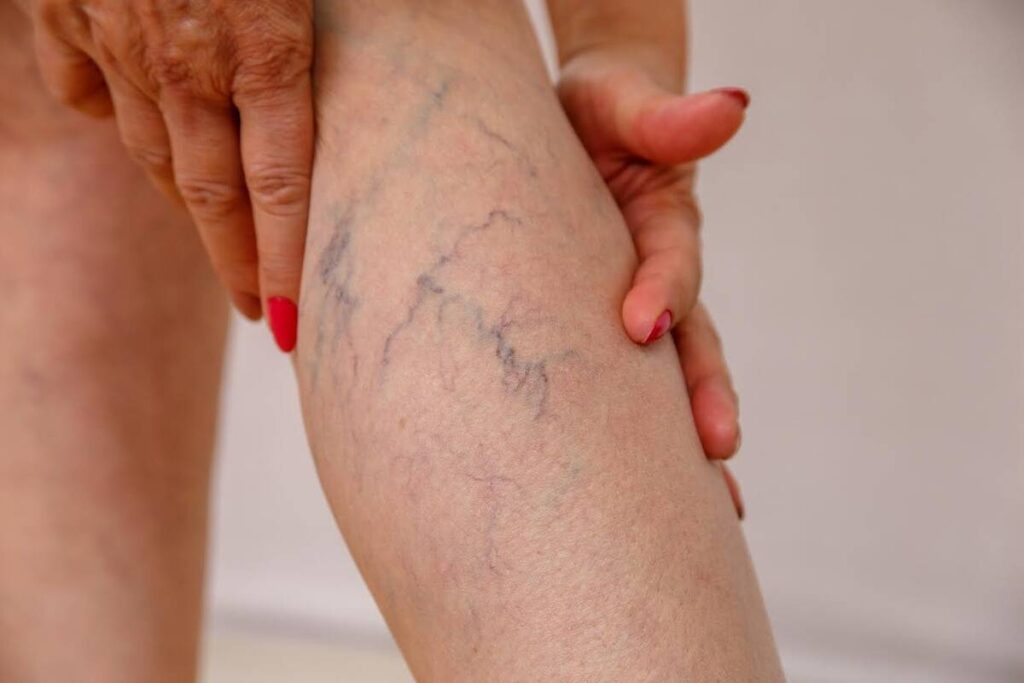 Obesidade e varizes têm relação e exigem atenção médica