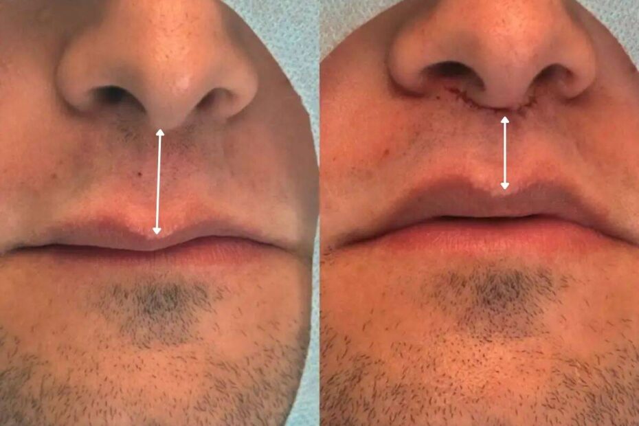 Lip Lift amplia opções de rejuvenescimento sem volume