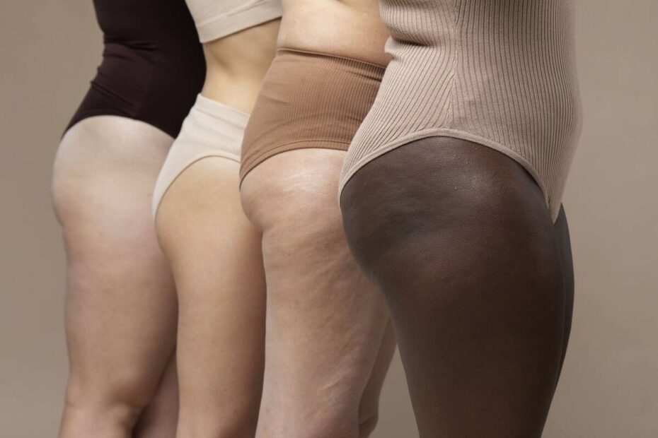 Lipedema vai além da estética e pode ter relação hormonal