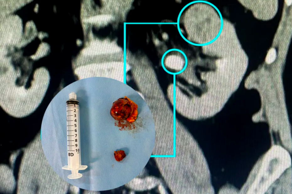 Nefrectomia robótica preserva rins com alta precisão