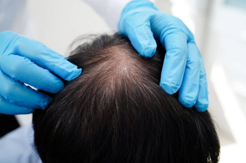 Calvície pode afetar autoestima de homens e mulheres