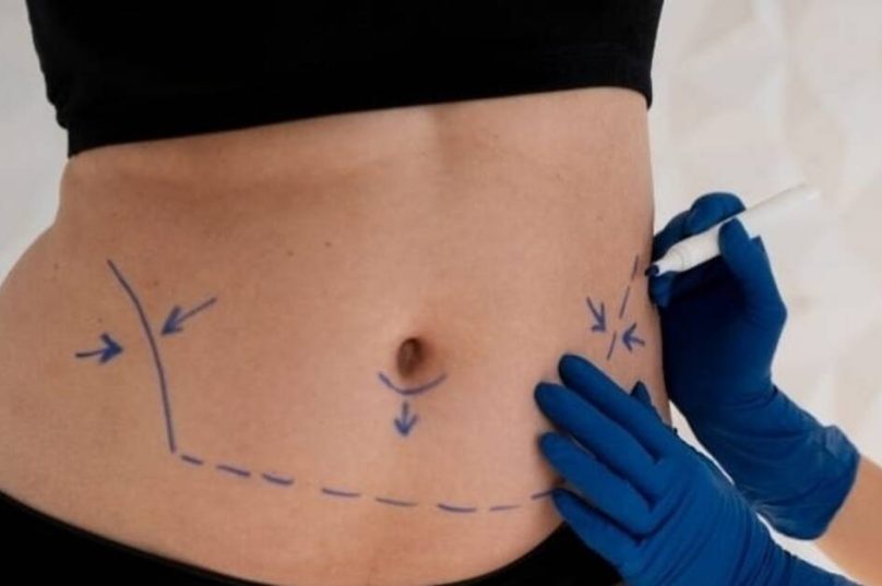 Mini ou abdominoplastia: especialista aponta melhor escolha