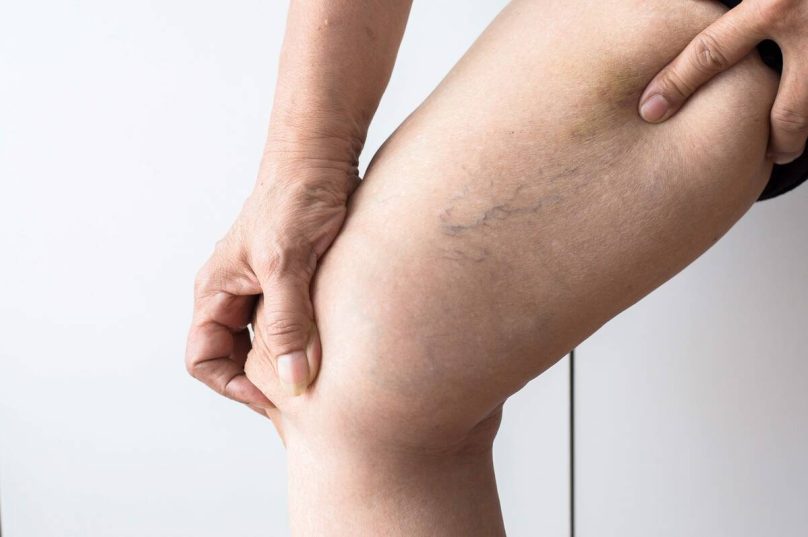 Tratamento de varizes evolui com métodos menos invasivos