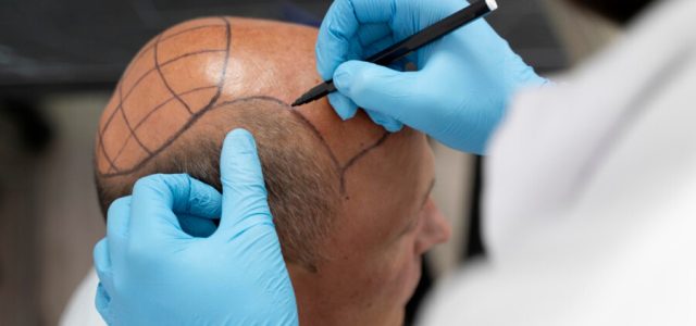 Transplante capilar: mercado crescerá 21% até 2032