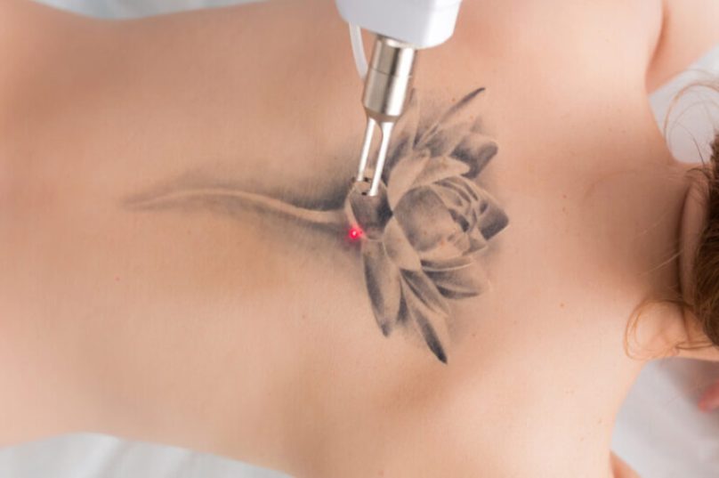 Remoção de tatuagens cresce e evolui suas técnicas
