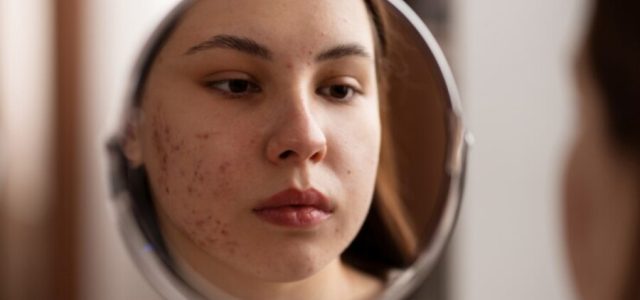 Acne se torna cada vez mais comum entre mulheres adultas