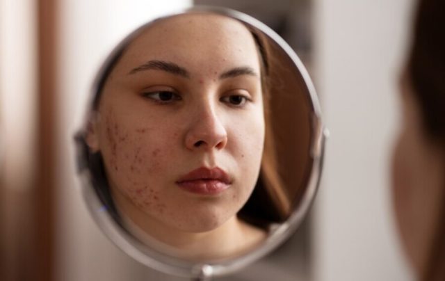 Acne se torna cada vez mais comum entre mulheres adultas