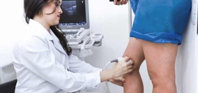 Laser endovenoso mira resultados contra varizes