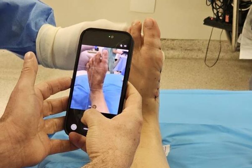 Tratamento das joanetes avança com cirurgia pouco invasiva Tratamento das joanetes avança com cirurgia pouco invasiva