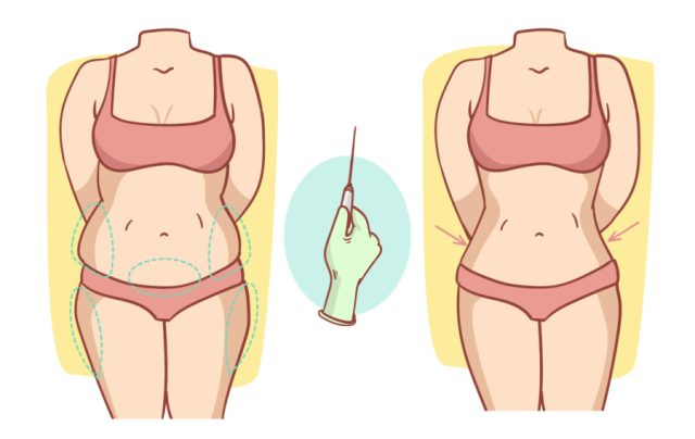 Lipoaspiração é a cirurgia plástica mais realizada no Brasil