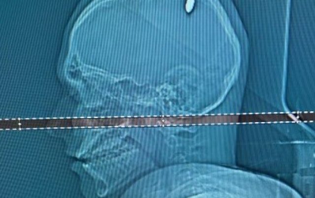 Tomografia realizada em hospital de Juiz de Fora mostra bala alojada na cabeça do estudante Foto Arquivo Pessoal