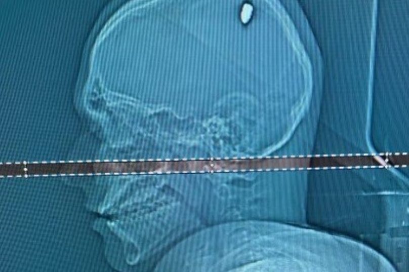 Tomografia realizada em hospital de Juiz de Fora mostra bala alojada na cabeça do estudante 

Foto Arquivo Pessoal