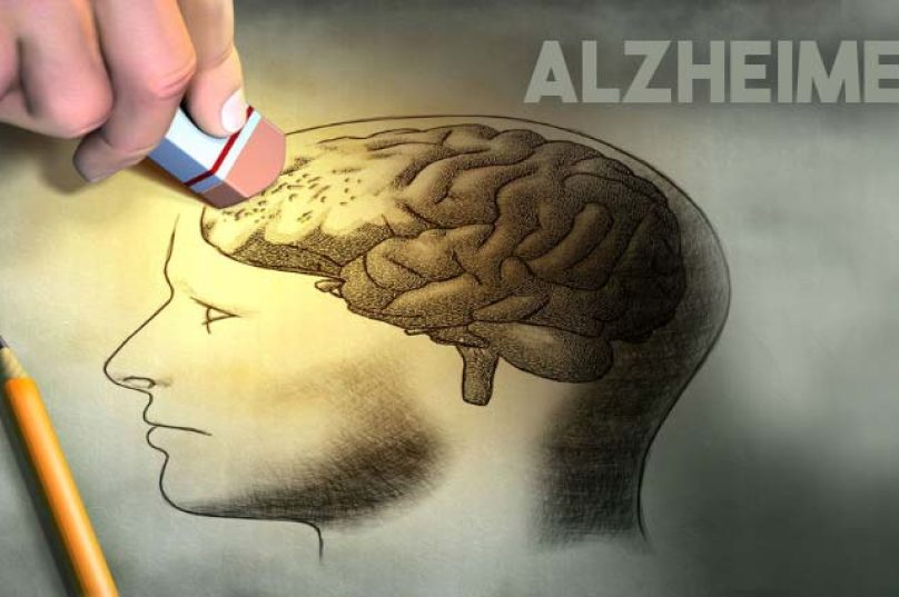 alzheimer