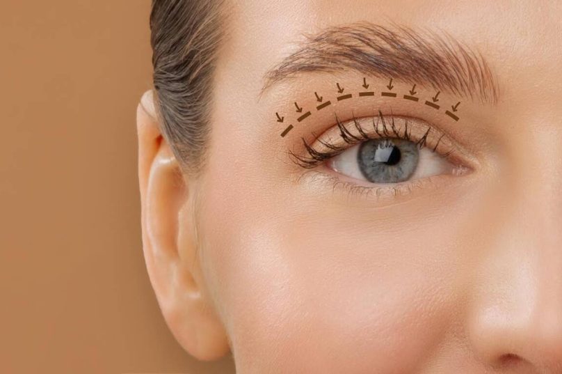 Blefaroplastia envolve função ocular além da estética