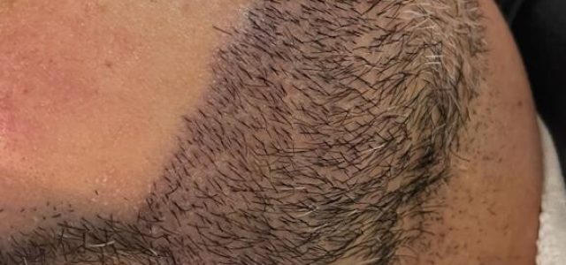 Transplante de barba cresce no mercado masculino