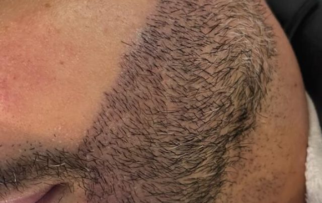 Transplante de barba cresce no mercado masculino