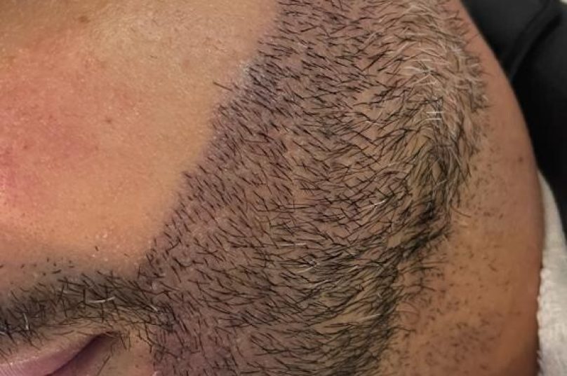 Transplante de barba cresce no mercado masculino