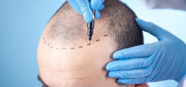 Busca por transplante capilar cresce no Brasil