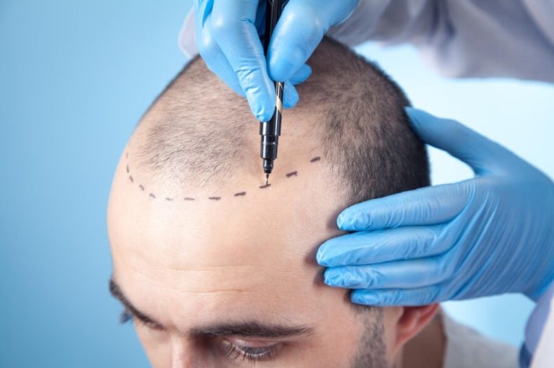 Busca por transplante capilar cresce no Brasil
