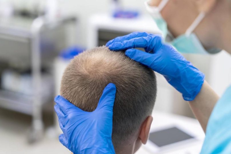 Medicina capilar avança e amplia possibilidade de tratamento