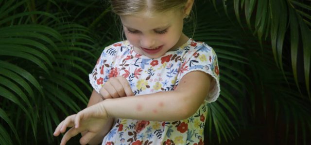 Picada de mosquito pode ser aliviada com cuidados especiais