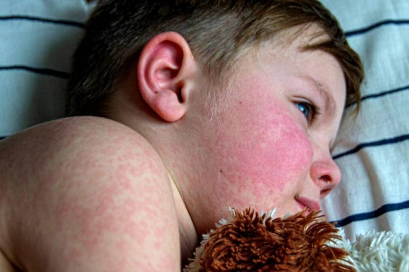 Queda da cobertura vacinal gera alerta para volta do sarampo