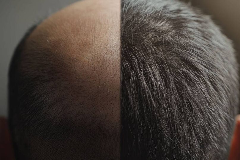 Demanda por transplante capilar valoriza resultados naturais