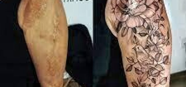 Tatuagem reparadora promete ajudar pessoas com cicatrizes