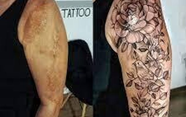 Tatuagem reparadora promete ajudar pessoas com cicatrizes