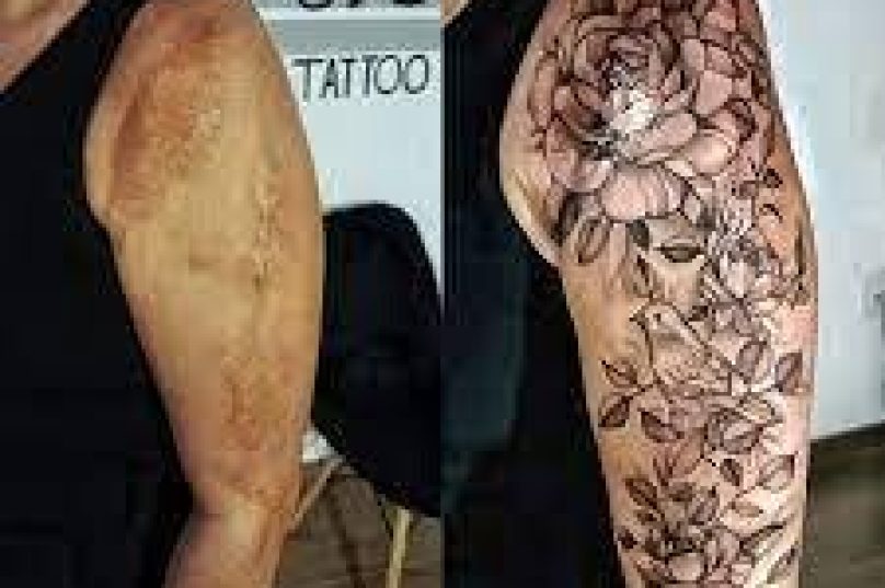 Tatuagem reparadora promete ajudar pessoas com cicatrizes