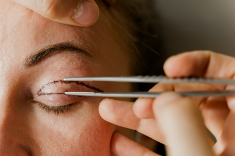 Blefaroplastia: procedimento que rejuvenesce o olhar