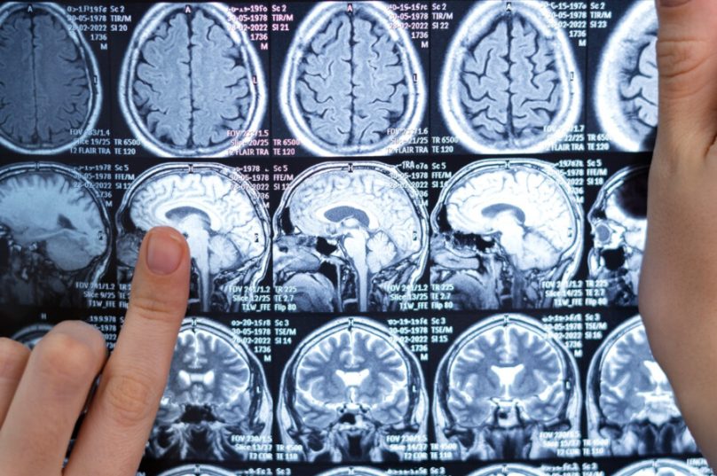 Incidência de AVC tem aumentado em jovens e pessoas de meia-idade