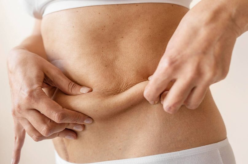 Tecnologia melhora retração da pele após lipoaspiração