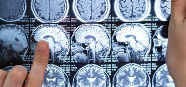 Neurocirurgião esclarece dúvidas sobre tumor cerebral