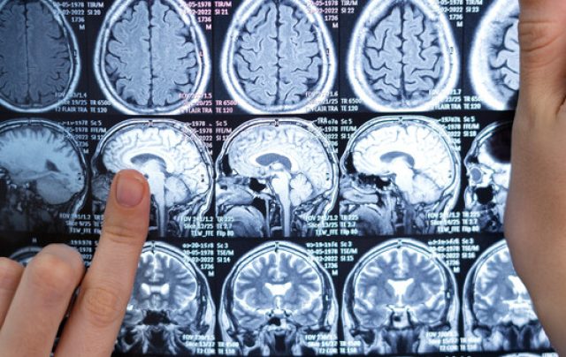 Neurocirurgião esclarece dúvidas sobre tumor cerebral