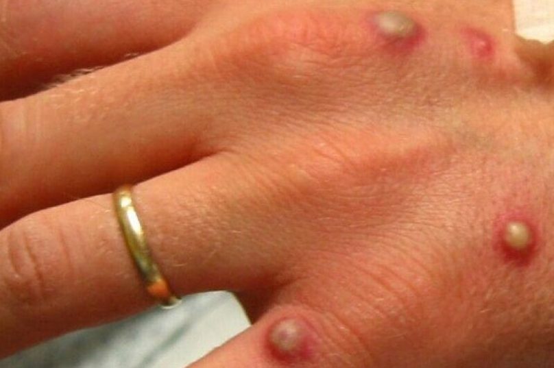 O paciente é homem, tem 25 anos e está sendo monitorado. Foto I Internet